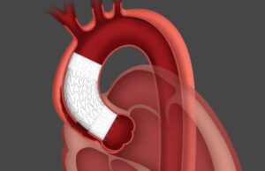 First patient treated in ARISE II study of Gore ascending stent graft