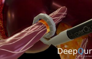 DeepQure advances clinical trials of its HyperQure extravascular renal denervation system