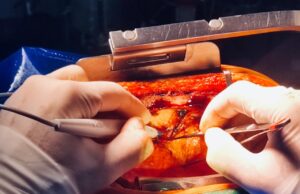 Research aims to understand training needs for left-handed cardiac surgeons
