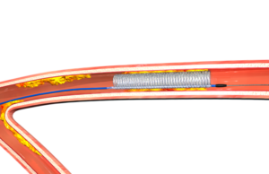 Preliminary IDE trial results demonstrate efficacy of dedicated device for coronary perforations