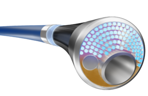 First patient enrolled in study of integrated laser atherectomy and IVL catheter
