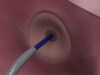 Protaryx Medical receives US FDA clearance for proprietary transseptal puncture device