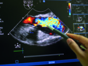 Heart teams digest role of early aortic intervention following EARLY TAVR and EVOLVED trials