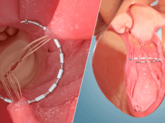 Enrolment milestone met in CORCINCH-HF pivotal trial