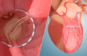 Enrolment milestone met in CORCINCH-HF pivotal trial
