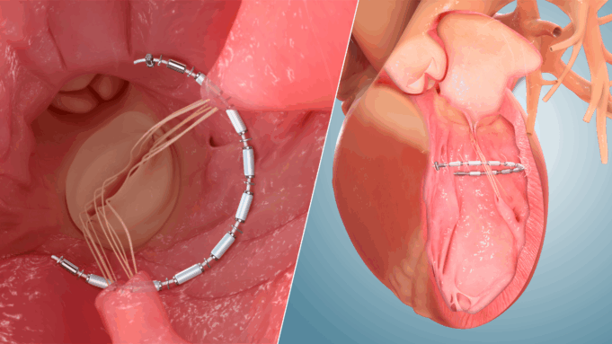 Enrolment milestone met in CORCINCH-HF pivotal trial