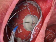RoseDoc system gets first-in-human use in tricuspid valve replacement cases