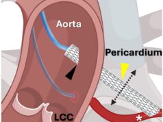 First-in-man VECTOR procedure offers new approach for preventing coronary obstruction