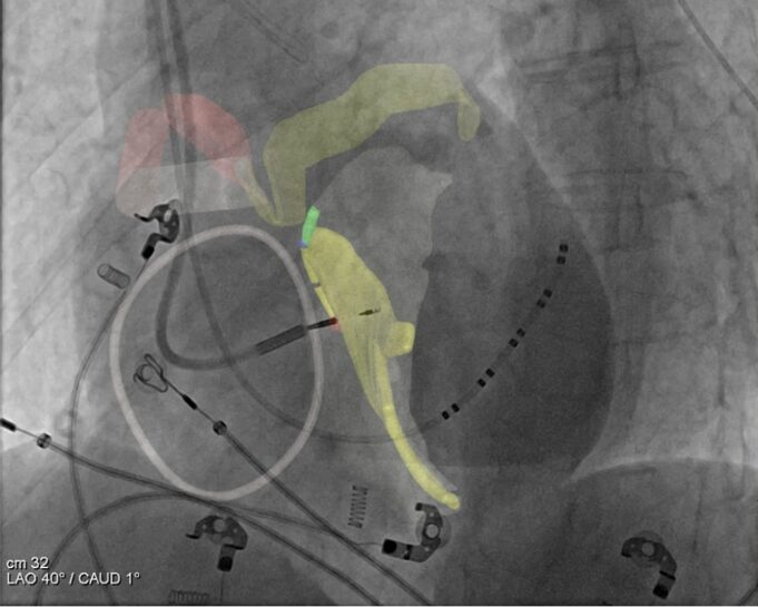 US FDA approves CT angiography system for visualising cardiac conduction system