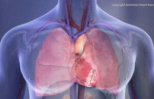 First ACC/AHA acute PE guidelines provide “roadmap” for management