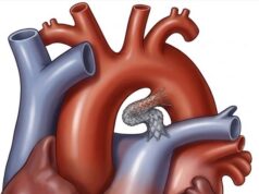 First baby treated with Lifeline stent system