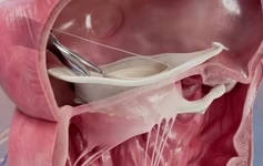 VDyne TTVR system approved for US IDE clinical trial