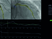 Trial data put coronary physiology on the cusp of an inflection point