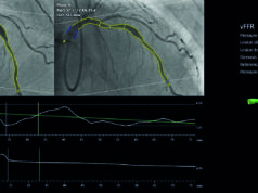 Trial data put coronary physiology on the cusp of an inflection point