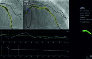 Trial data put coronary physiology on the cusp of an inflection point