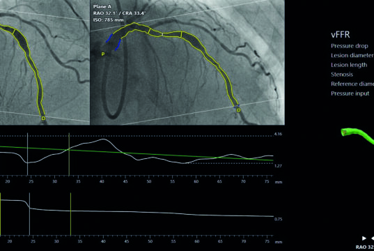 Trial data put coronary physiology on the cusp of an inflection point