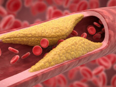 Presence of modifiable risk factors associated with greater coronary plaque burden