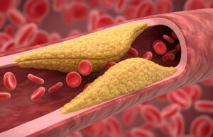Presence of modifiable risk factors associated with greater coronary plaque burden