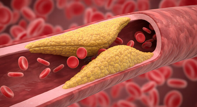 Presence of modifiable risk factors associated with greater coronary plaque burden