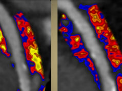 AI-powered coronary inflammation quantification tool given US FDA de novo authorisation