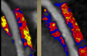 AI-powered coronary inflammation quantification tool given US FDA de novo authorisation