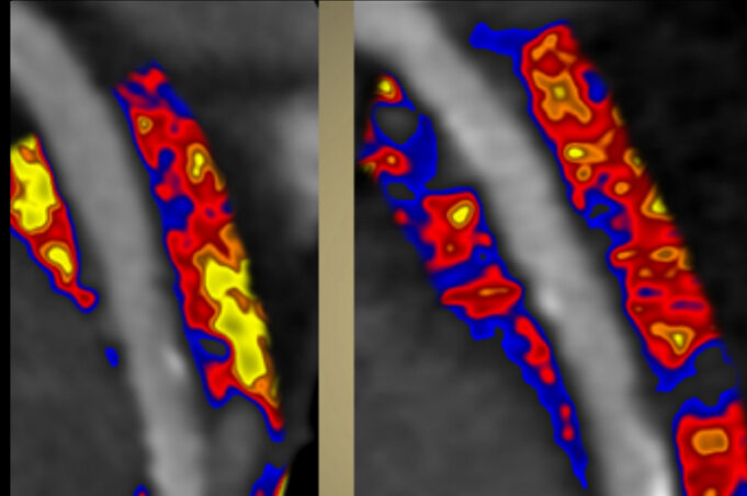AI-powered coronary inflammation quantification tool given US FDA de novo authorisation