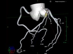 AI cardiovascular diagnostic specialist Elucid completes latest financing round