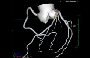 AI cardiovascular diagnostic specialist Elucid completes latest financing round