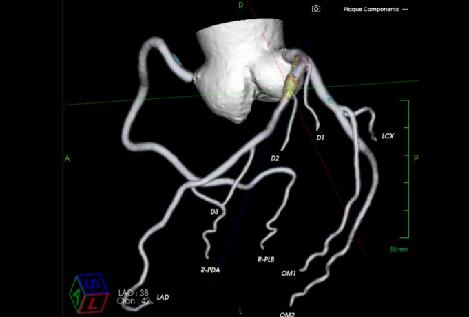 AI cardiovascular diagnostic specialist Elucid completes latest financing round