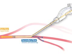 iPerf concludes clinical trial of novel dual-lumen femoral arterial cannula for cardiopulmonary support