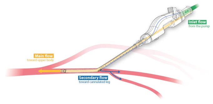 iPerf concludes clinical trial of novel dual-lumen femoral arterial cannula for cardiopulmonary support