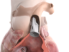Size adjustable pulmonary valve gains US FDA approval