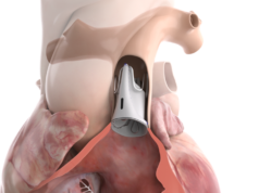 Size adjustable pulmonary valve gains US FDA approval