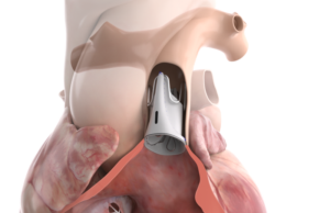 Size adjustable pulmonary valve gains US FDA approval