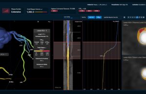 Non-invasive FFR tool gains US FDA clearance